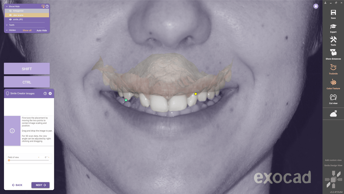 Facially-Driven Smile Designs: A virtual introductory training series