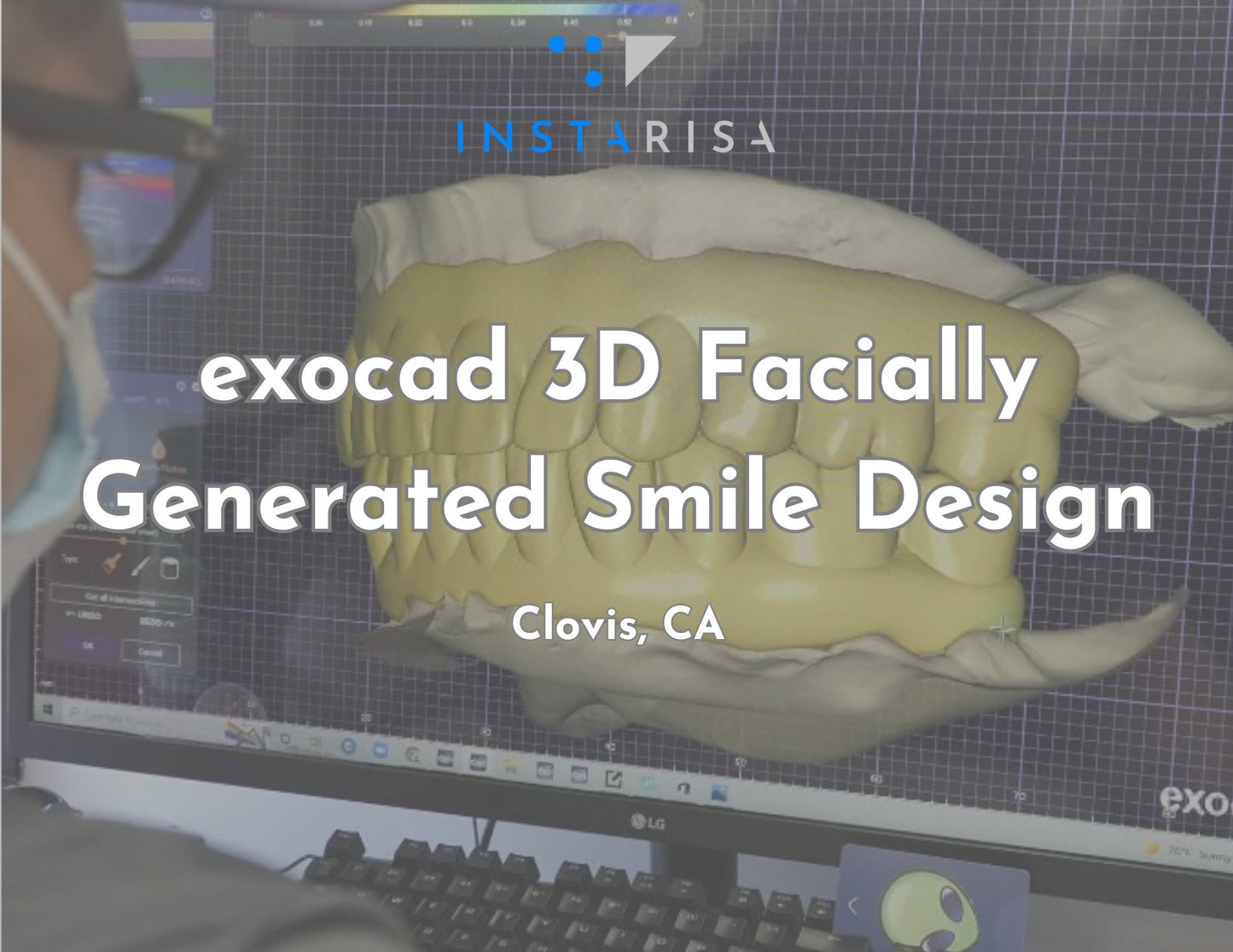 exocad 3D Facially Generated Smile Design (Clovis, CA)
