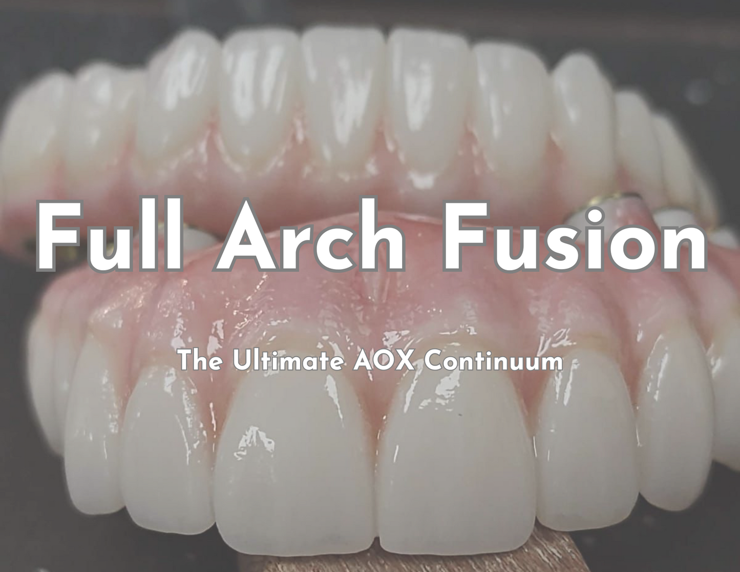 Full Arch Fusion: The Ultimate AOX Continuum